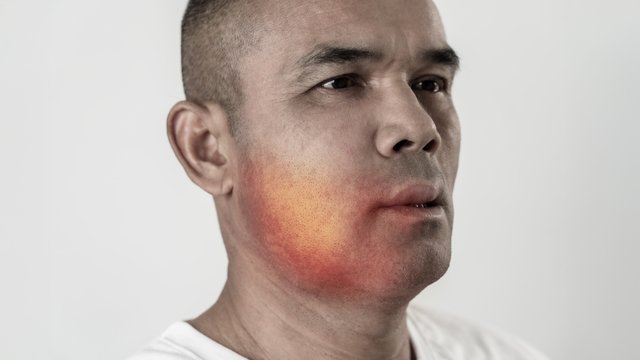 Anaphylaxis